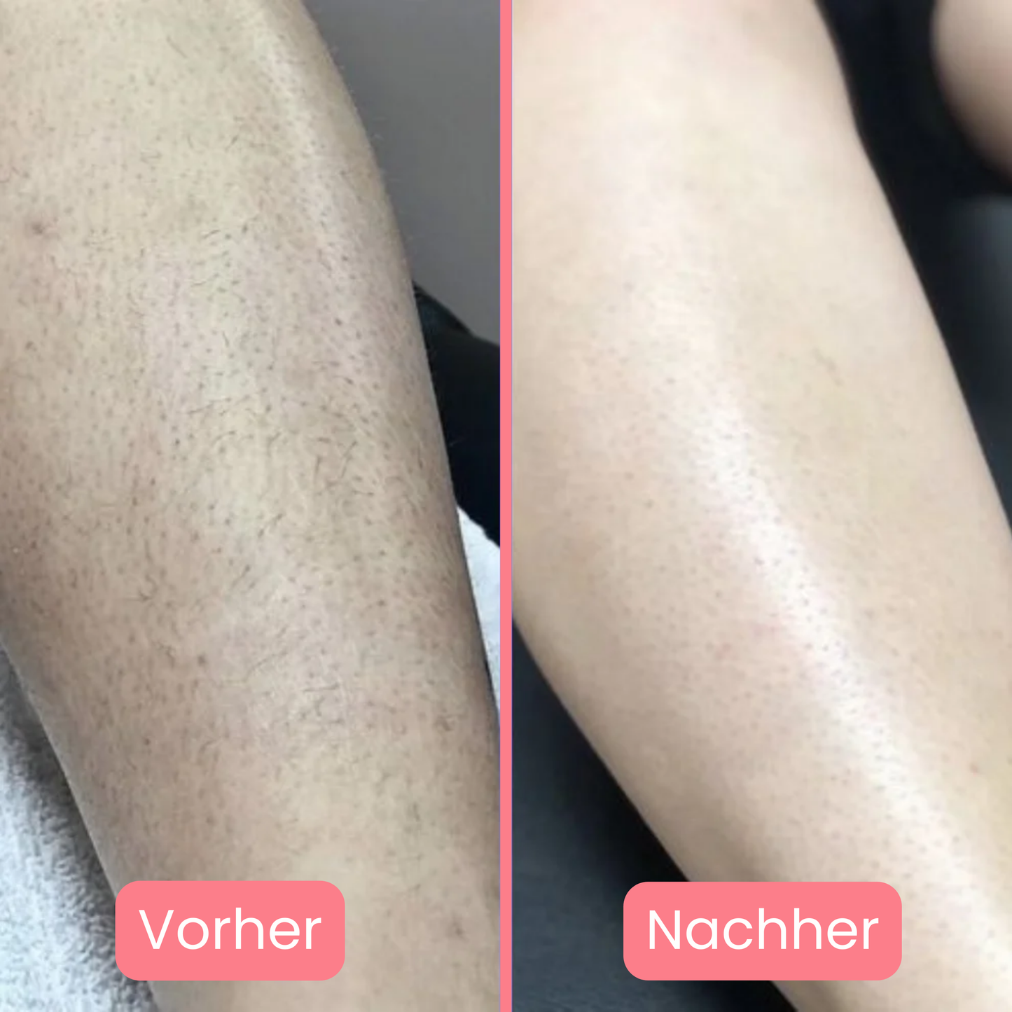 Skinlux - Daloper`s Lasergerät