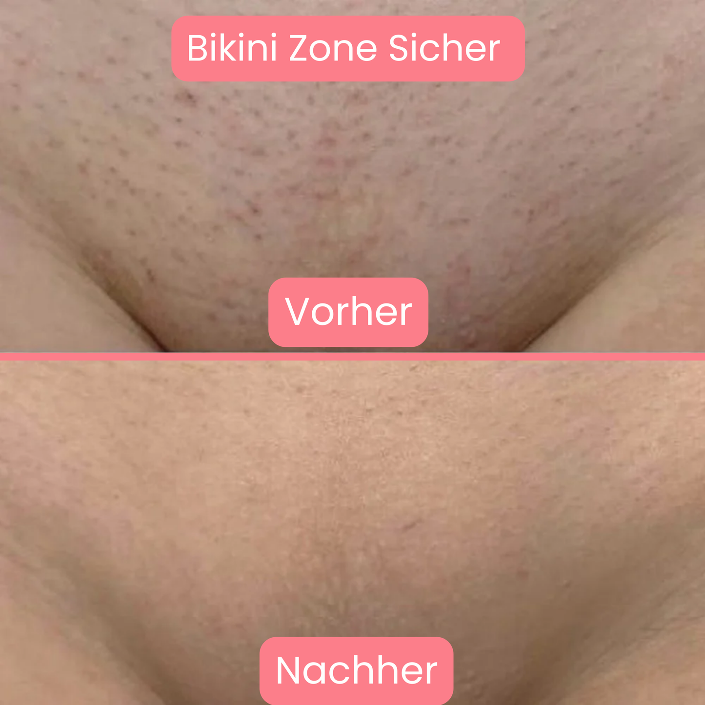 Skinlux - Daloper`s Lasergerät