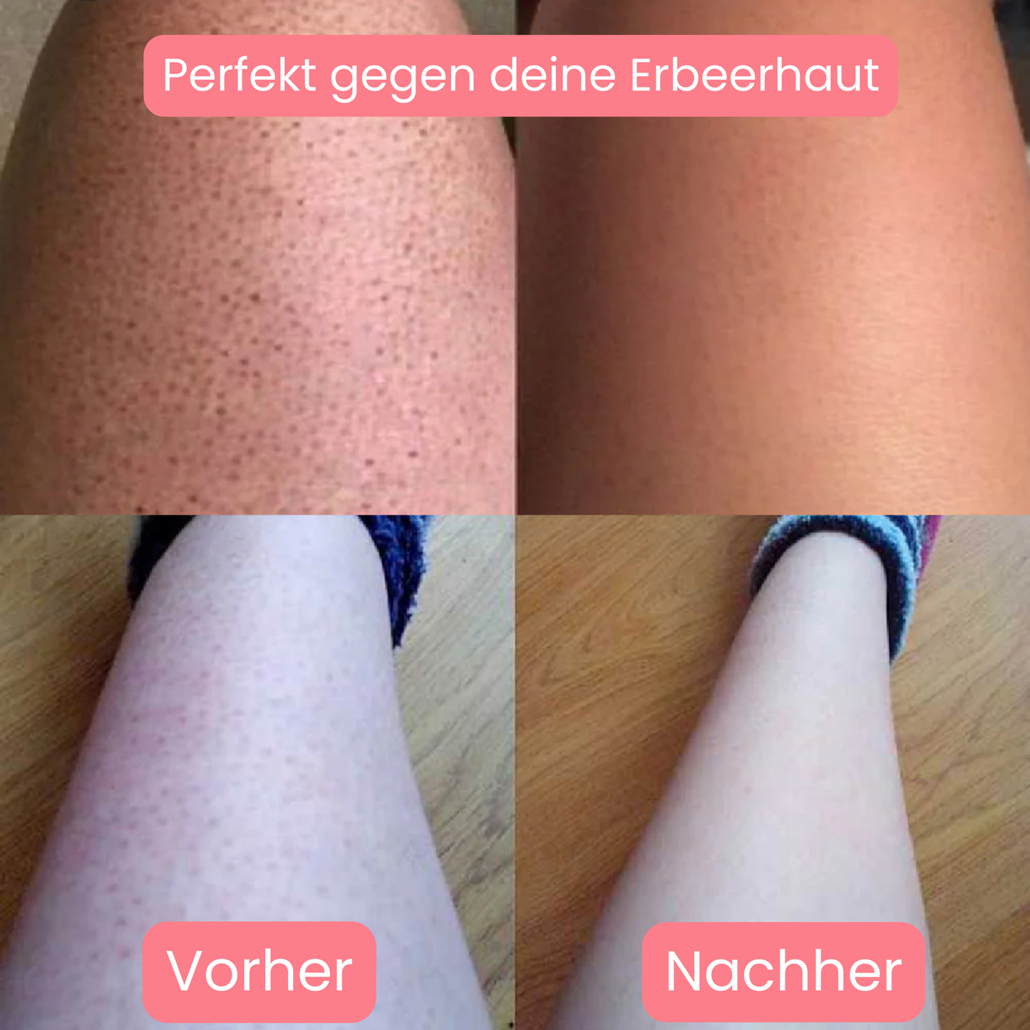 Skinlux - Daloper`s Lasergerät