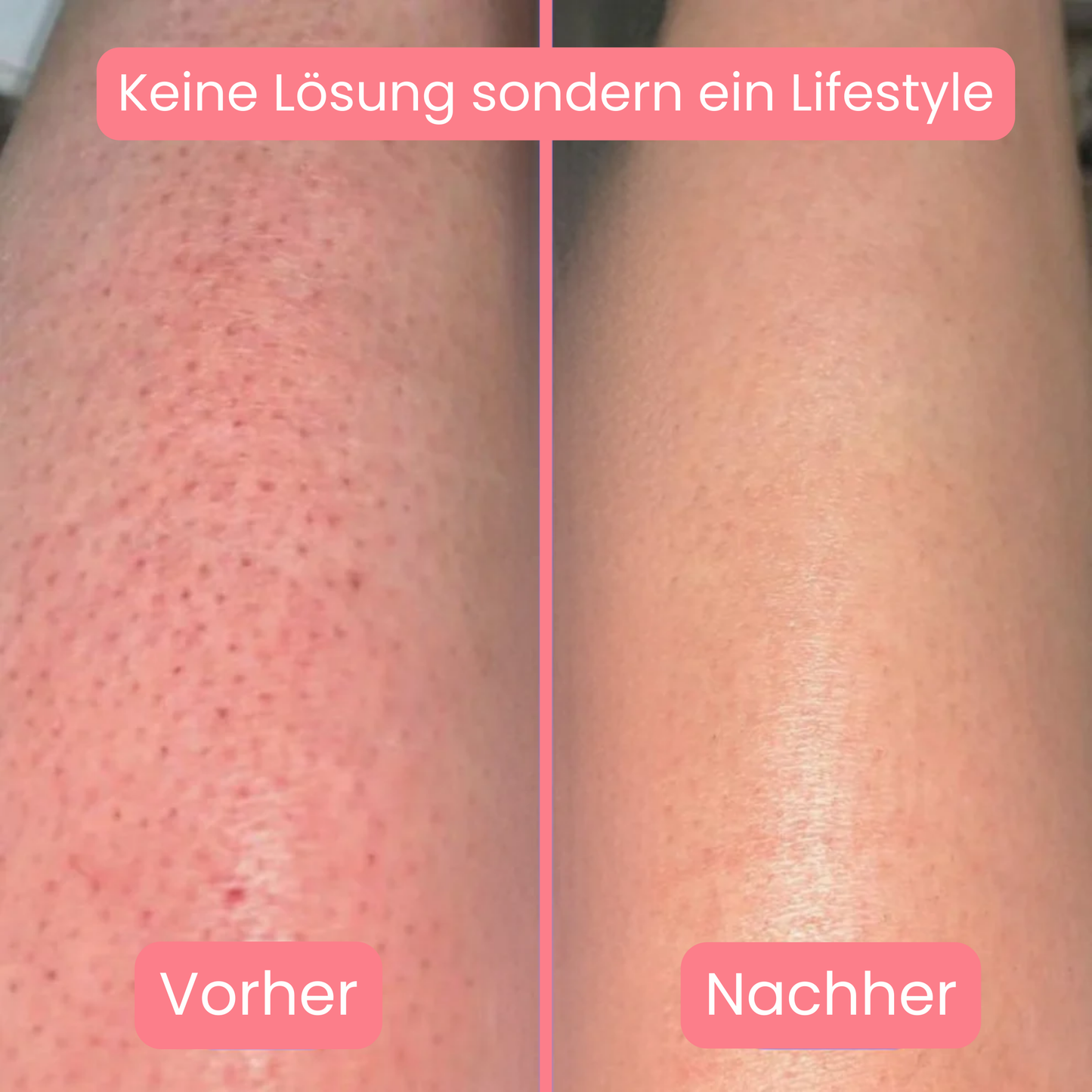 Skinlux - Daloper`s Lasergerät